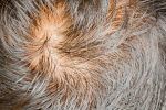 Qué es la alopecia areata