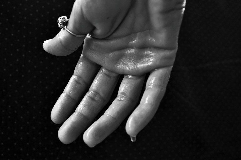 Hiperidrosis