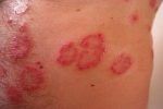 Dermatitis atópica y cuidados en el hogar