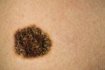 Los tipos de cáncer de piel